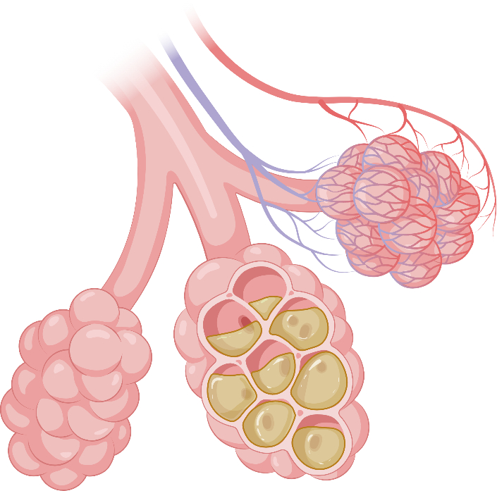 This is a cartoon image of alveoli in the lung. A cutaway shows the accumulation of mucus in the alveoli.